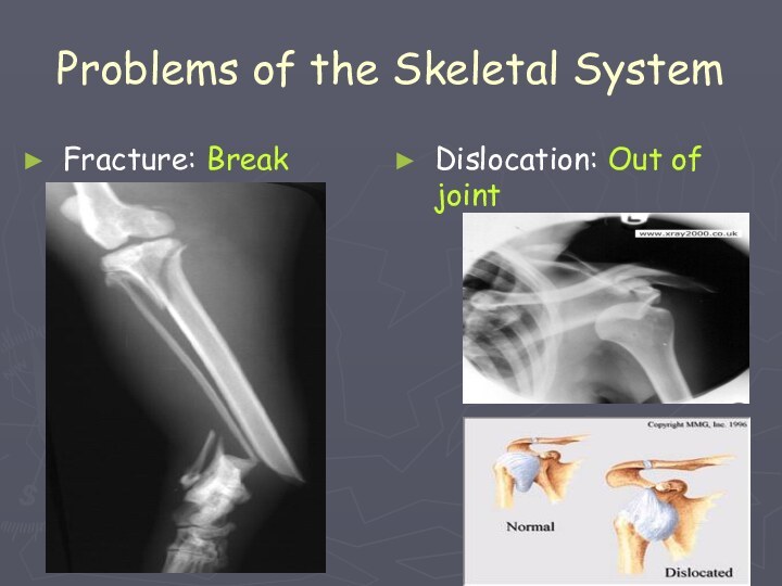 Problems of the Skeletal SystemFracture: BreakDislocation: Out of joint