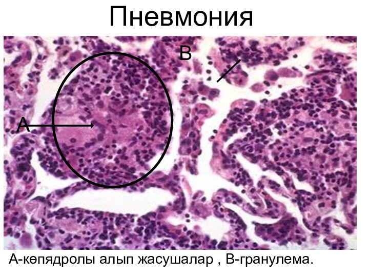 ПневмонияА-көпядролы алып жасушалар , В-гранулема.АВ