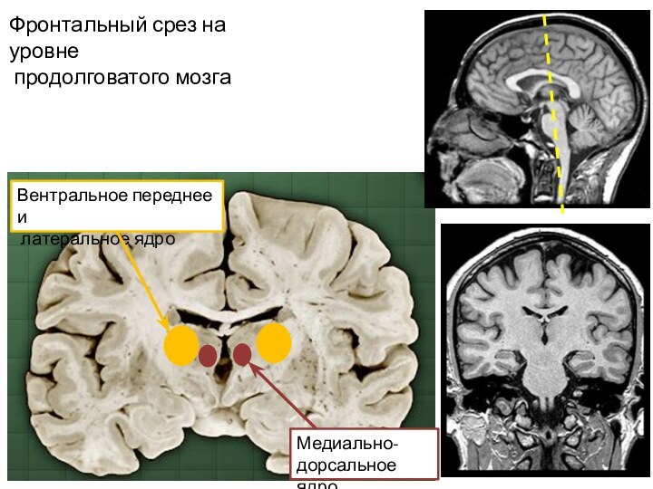 Фронтальный срез на уровне  продолговатого мозга