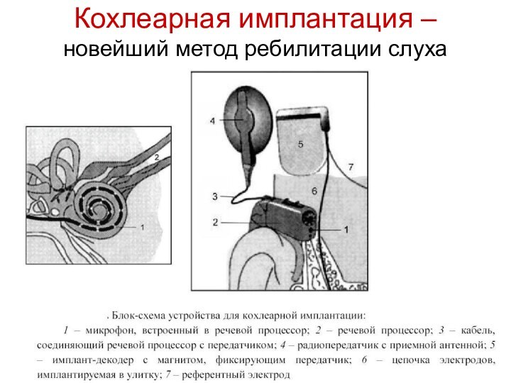 Кохлеарная имплантация – новейший метод ребилитации слуха