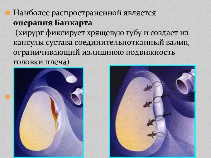 Наиболее распространенной является операция Банкарта  (хирург фиксирует хрящевую губу и создает