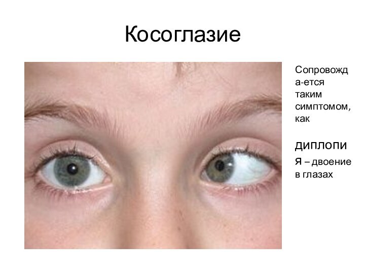 Косоглазие Сопровожда-ется таким симптомом, как диплопия – двоение в глазах