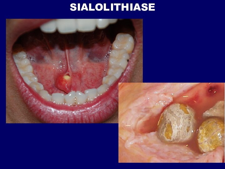 SIALOLITHIASE