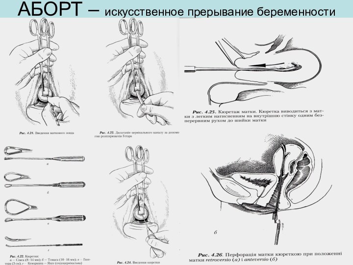 АБОРТ – искусственное прерывание беременности