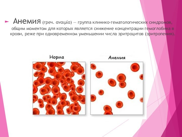 Анемия (греч. αναιμία) — группа клинико-гематологических синдромов, общим моментом для которых является