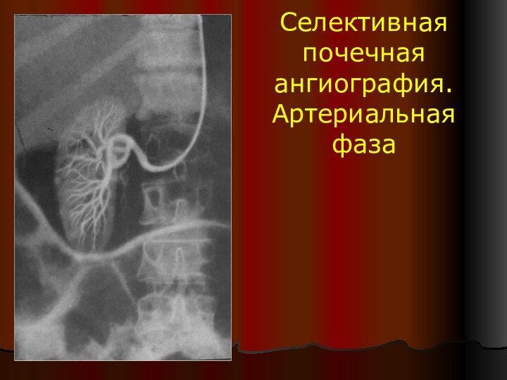 Селективная почечная ангиография. Артериальная фаза