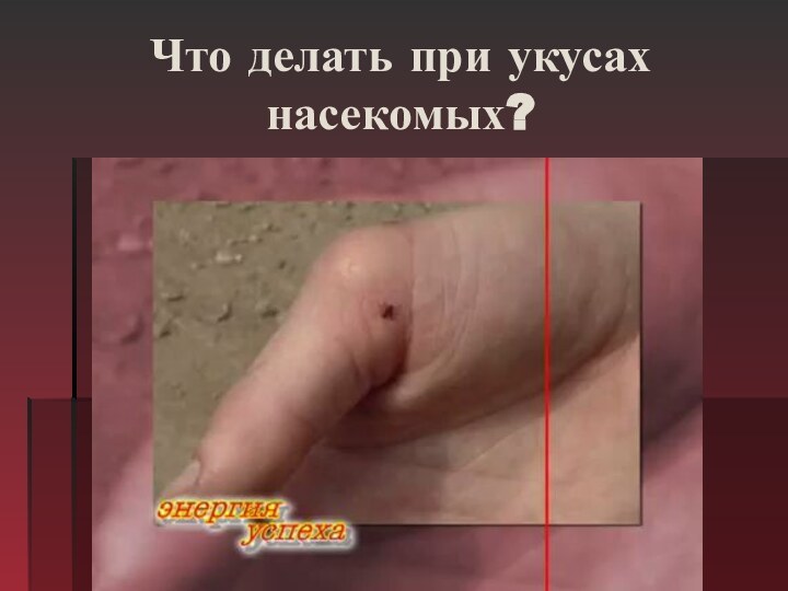 Что делать при укусах насекомых?