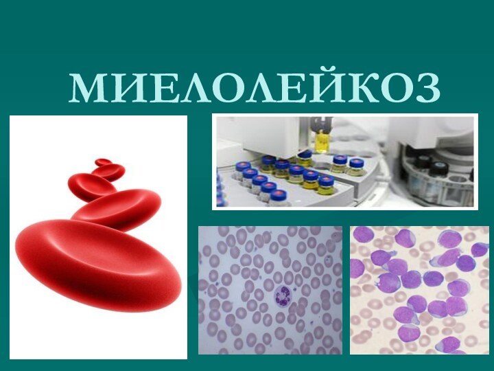 МИЕЛОЛЕЙКОЗ