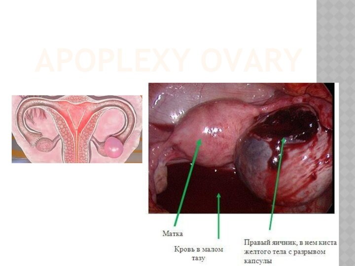 APOPLEXY OVARY