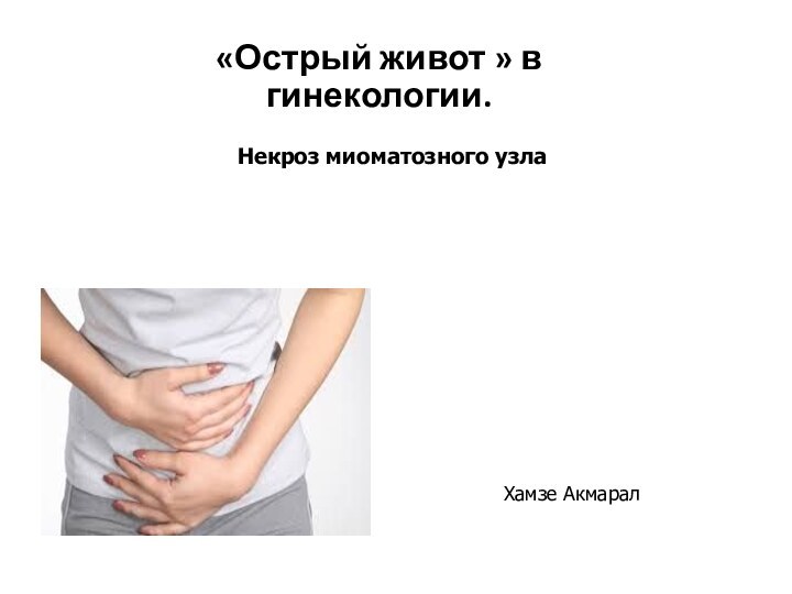 «Острый живот » в гинекологии. Хамзе АкмаралНекроз миоматозного узла