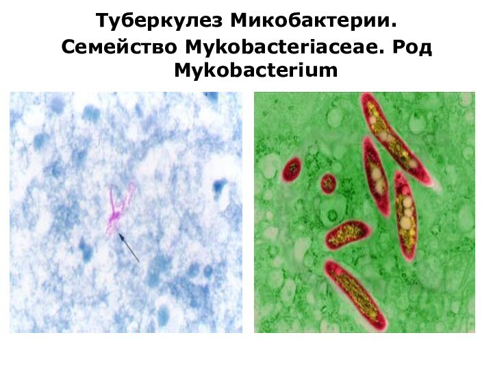 Туберкулез Микобактерии.Семейство Mykobacteriaceae. Род Mykobacterium