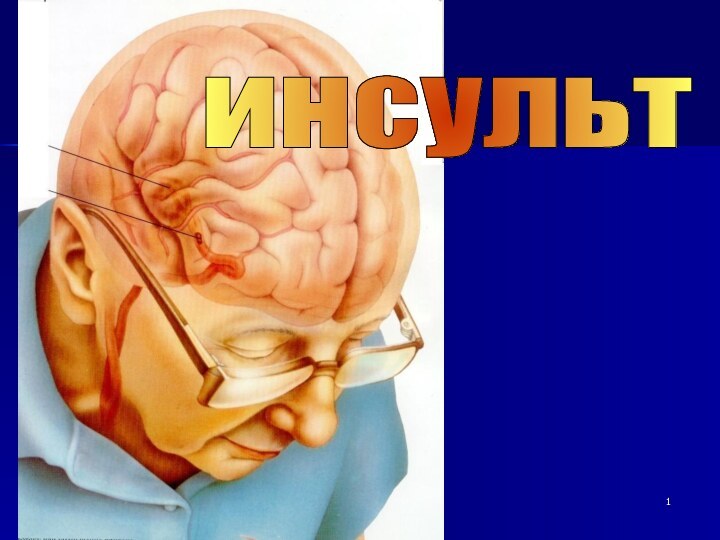 инсульт