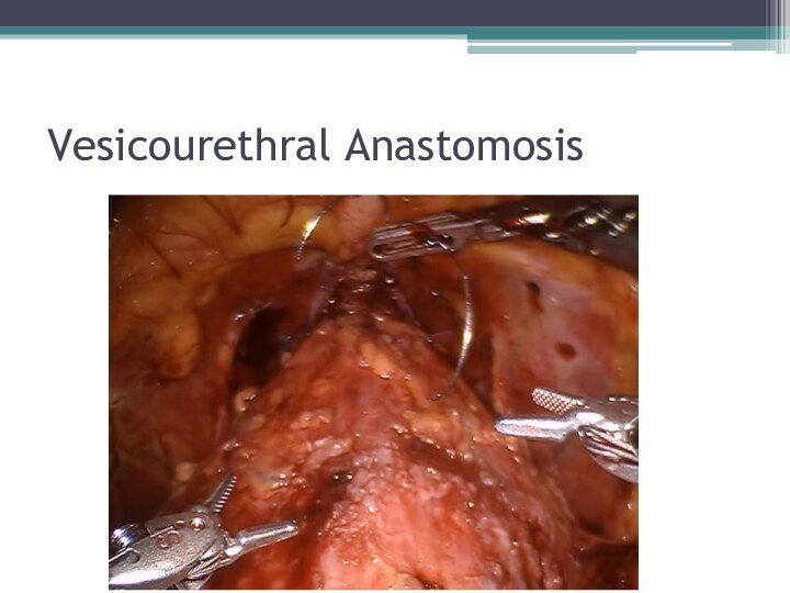 Vesicourethral Anastomosis