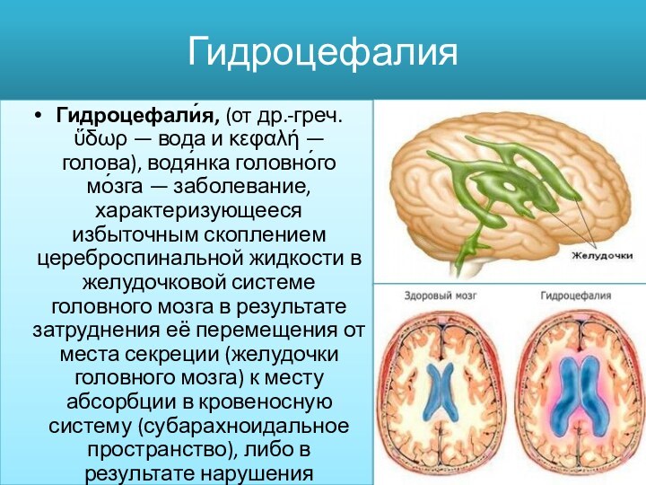 ГидроцефалияГидроцефали́я, (от др.-греч. ὕδωρ — вода и κεφαλή — голова), водя́нка головно́го мо́зга — заболевание,