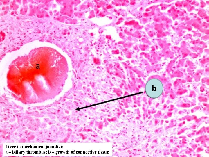 Liver in mechanical jaundiceа – biliary thrombus; b – growth of connective tissueb