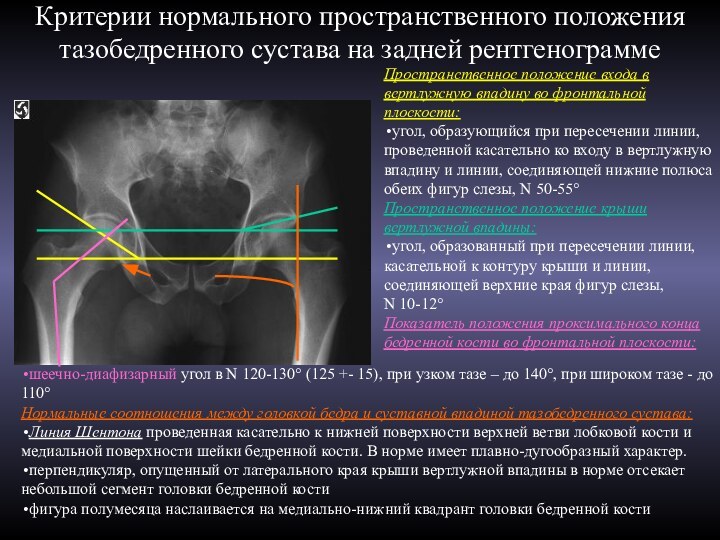 Критерии нормального пространственного положения тазобедренного сустава на задней рентгенограммеПространственное положение входа в