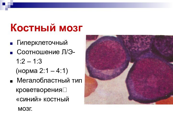 Костный мозгГиперклеточныйСоотношение Л/Э-  1:2 – 1:3  (норма 2:1 – 4:1)Мегалобластный