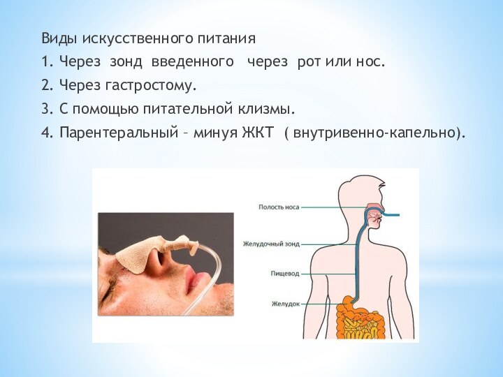 Виды искусственного питания1. Через зонд введенного  через рот или нос.2. Через