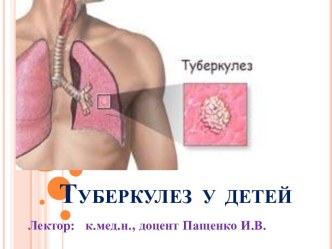 Туберкулез у детей