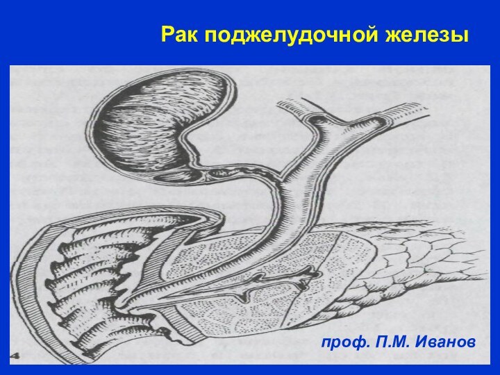 Рак поджелудочной железы      проф. П.М. Иванов