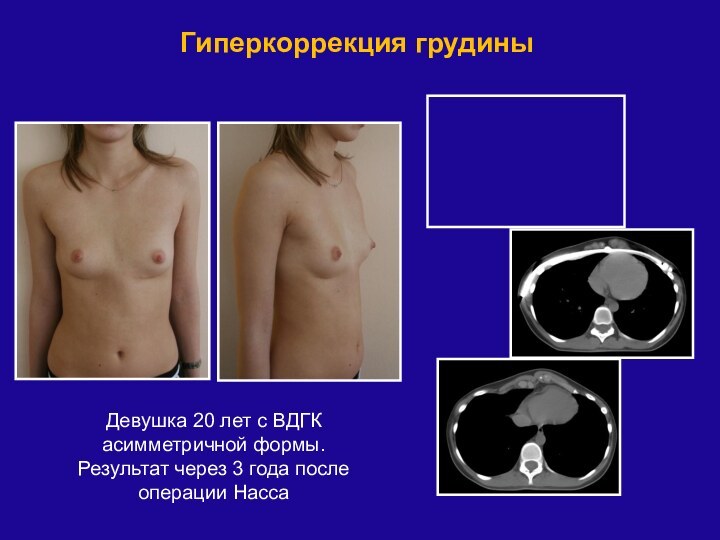 Гиперкоррекция грудиныДевушка 20 лет с ВДГК асимметричной формы. Результат через 3 года после операции Насса