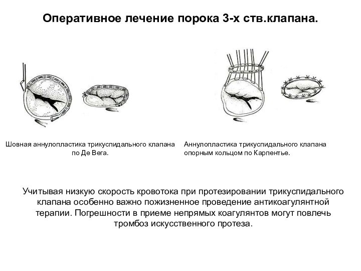 Оперативное лечение порока 3-х ств.клапана.Шовная аннулопластика трикуспидального клапана по Де Вега.Аннулопластика трикуспидального