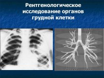 Рентгенологическое исследование легких. Лекция 7