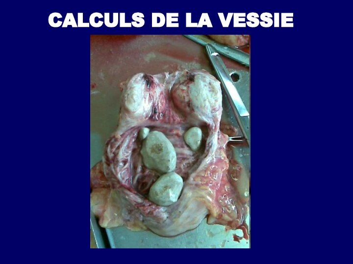 CALCULS DE LA VESSIE