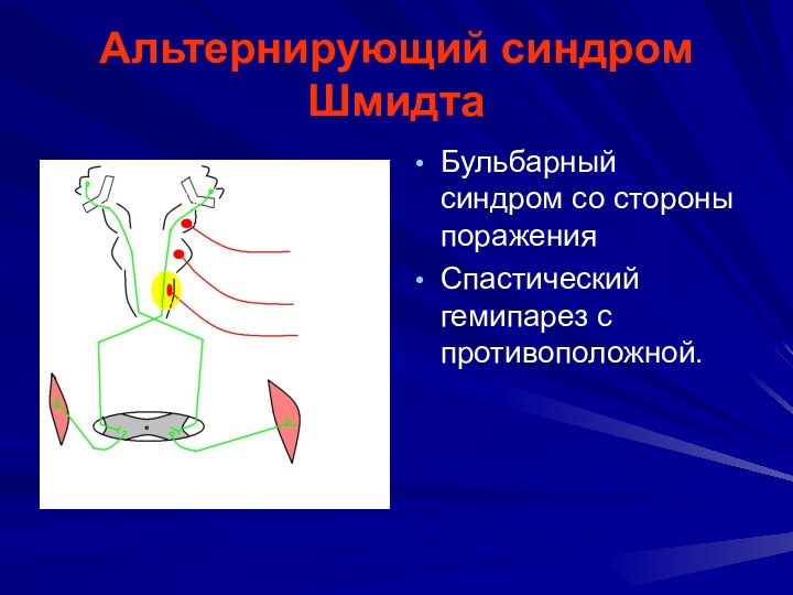 Альтернирующий синдром ШмидтаБульбарный синдром со стороны поражения Спастический гемипарез с противоположной.