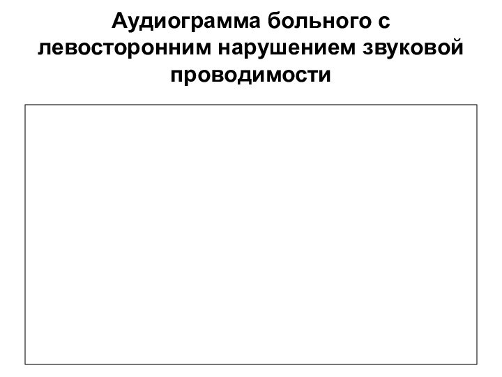 Аудиограмма больного с левосторонним нарушением звуковой проводимости