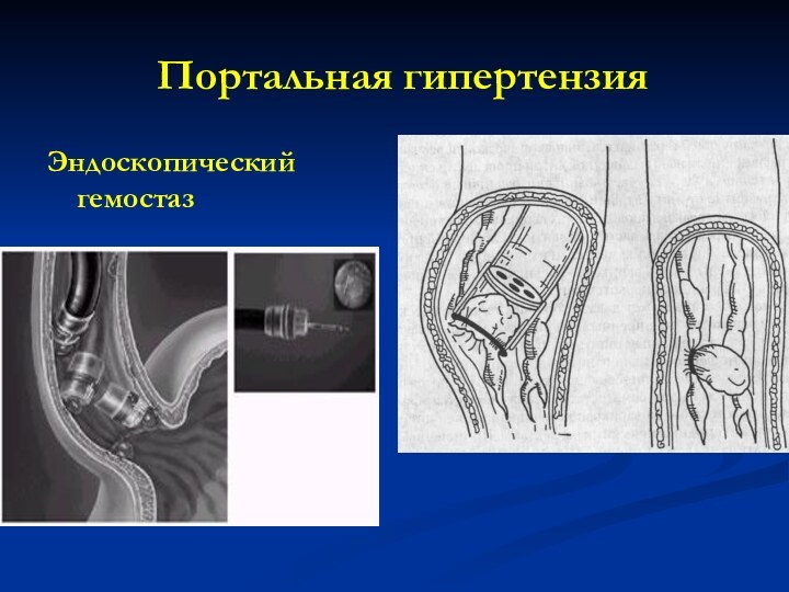 Портальная гипертензияЭндоскопический гемостаз