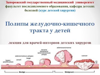 Полипы желудочно-кишечного тракта у детей