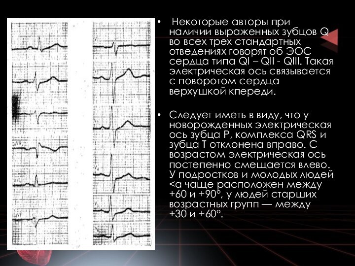 Некоторые авторы при наличии выраженных зубцов Q во всех трех стандартных