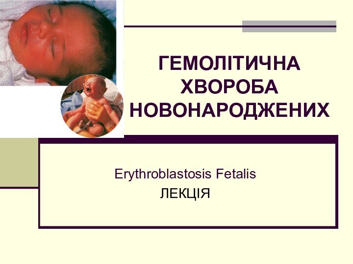 ГЕМОЛІТИЧНА ХВОРОБА НОВОНАРОДЖЕНИХErythroblastosis FetalisЛЕКЦІЯ