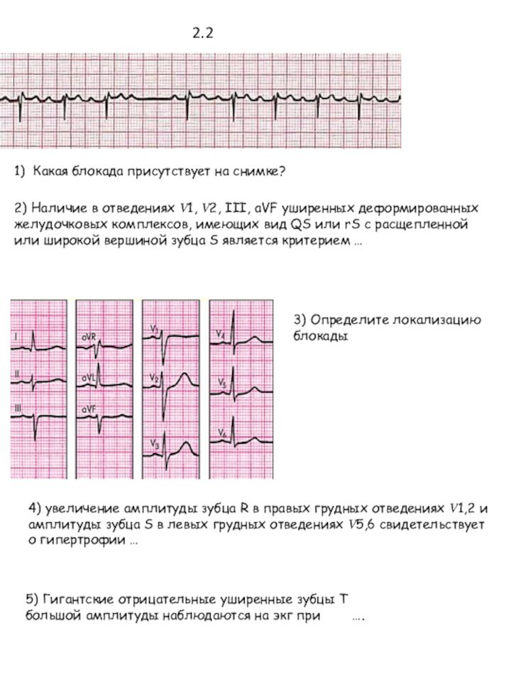 1) Какая блокада присутствует на снимке? 2) Наличие в отведениях ?1, ?2,