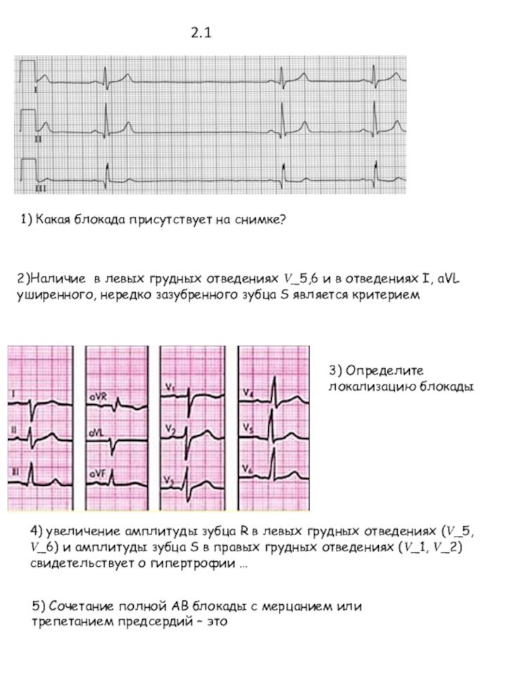 1) Какая блокада присутствует на снимке?2)Наличие в левых грудных отведениях ?_5,6 и