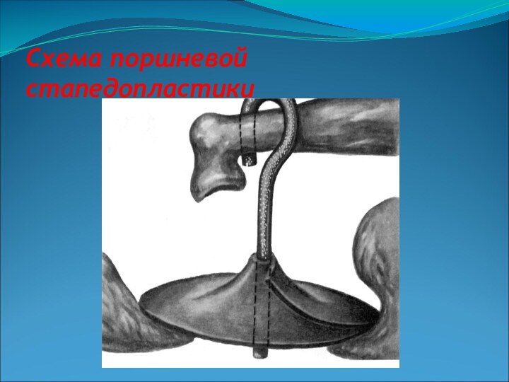 Схема поршневой стапедопластики