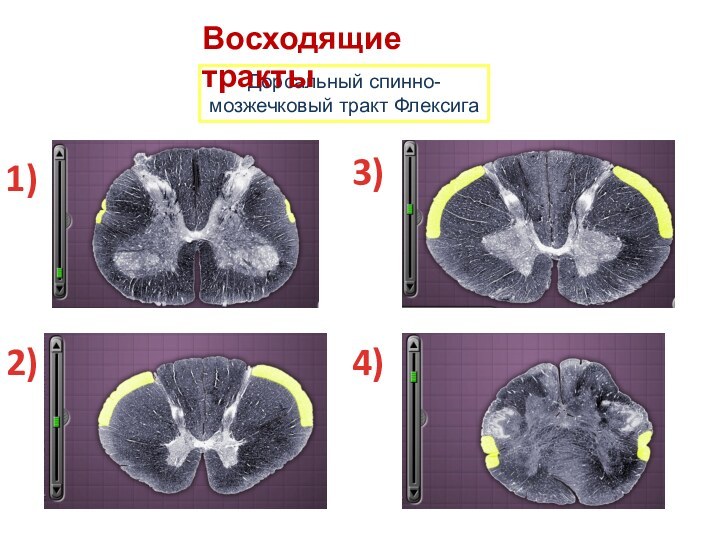 Дорсальный спинно-мозжечковый тракт ФлексигаВосходящие тракты1)2)3)4)