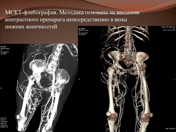 МСКТ-флебография. Методика основана на введении контрастного препарата непосредственно в вены нижних конечностей