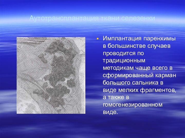 Аутотрансплантация ткани селезенкиИмплантация паренхимы в большинстве случаев проводится по традиционным методикам чаще