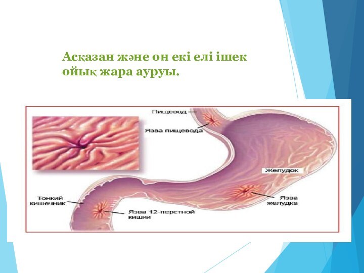 Асқазан және он екі елі ішек ойық жара ауруы.