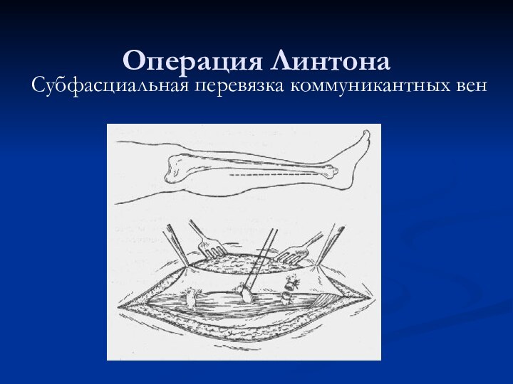 Операция ЛинтонаСубфасциальная перевязка коммуникантных вен