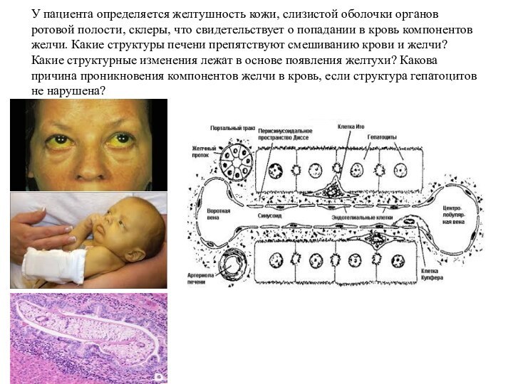 У пациента определяется желтушность кожи, слизистой оболочки органов ротовой полости, склеры, что