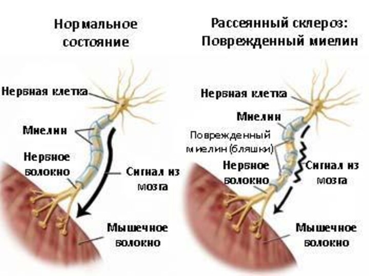 Рассеянный склероз презентация