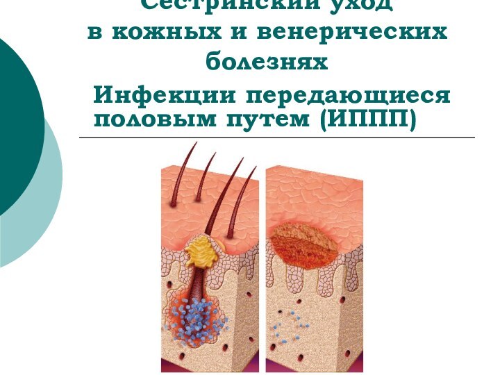 Сестринский уход  в кожных и венерических болезняхИнфекции передающиеся половым путем (ИППП)