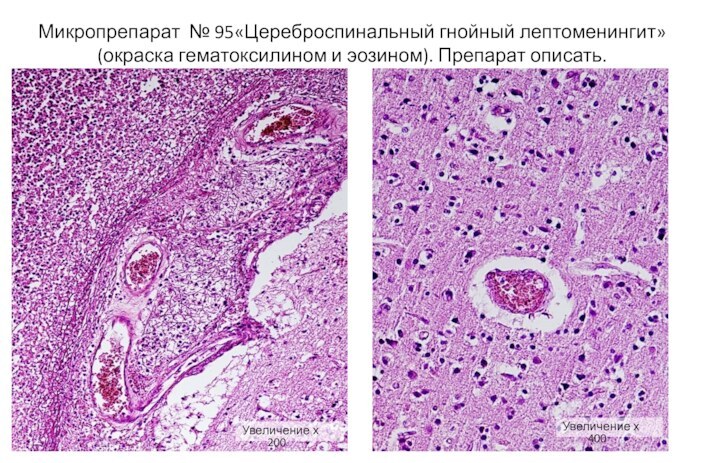 Микропрепарат № 95«Цереброспинальный гнойный лептоменингит» (окраска гематоксилином и эозином). Препарат описать.Увеличение х 200Увеличение х 400