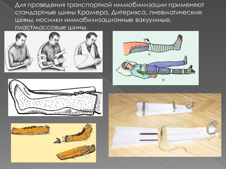 Для проведения транспортной иммобилизации применяют стандартные шины Крамера, Дитерихса, пневматические шины, носилки иммобилизационные вакуумные, пластмассовые шины.