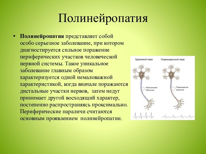 ПолинейропатияПолинейропатия представляет собой особо серьезное заболевание, при котором диагностируется сильное поражение периферических участков