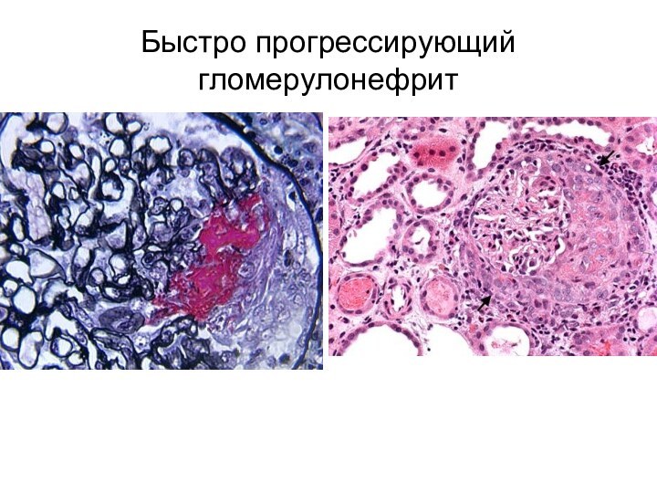 Быстро прогрессирующий гломерулонефрит