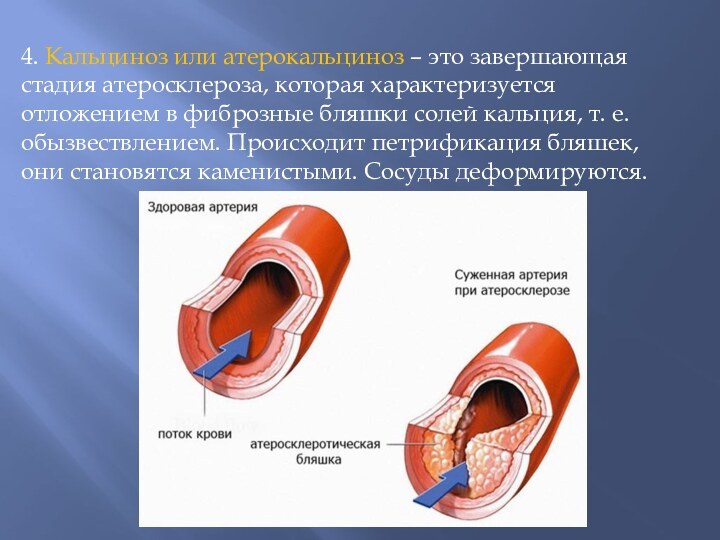 2 стадия атеросклероза